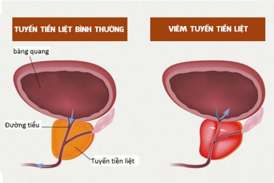 viem-tuyen-tien-liet.jpg