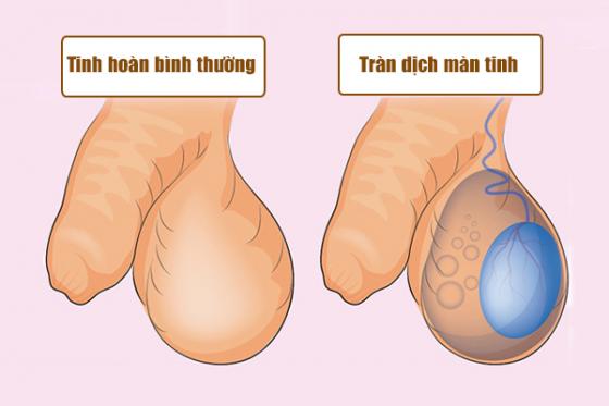 benh-o-biu-tinh-hoan-2.jpg